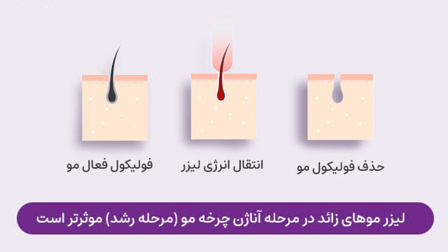 مراحل حذف مو زائد توسط لیزر مراحل حذف مو زائد توسط لیزر