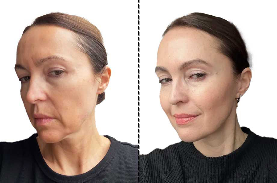 نتیجه اندولیفت صورت نتیجه اندولیفت صورت