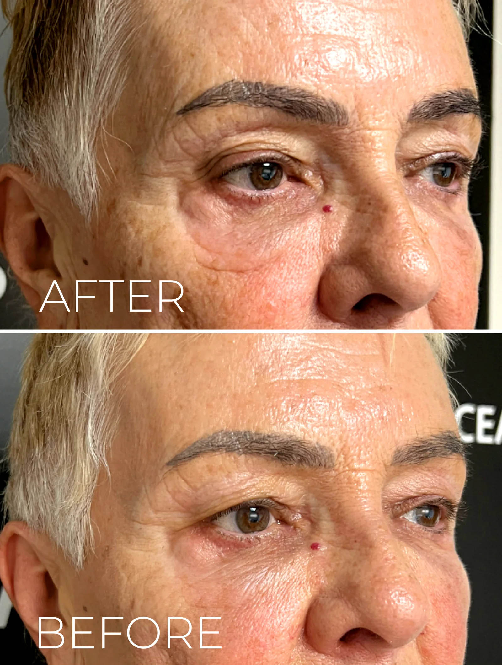 اثرگذاری اندولیفت صورت اثرگذاری اندولیفت صورت