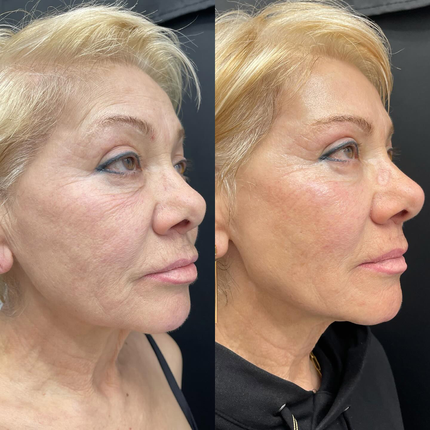 اندولیفت صورت اندولیفت صورت