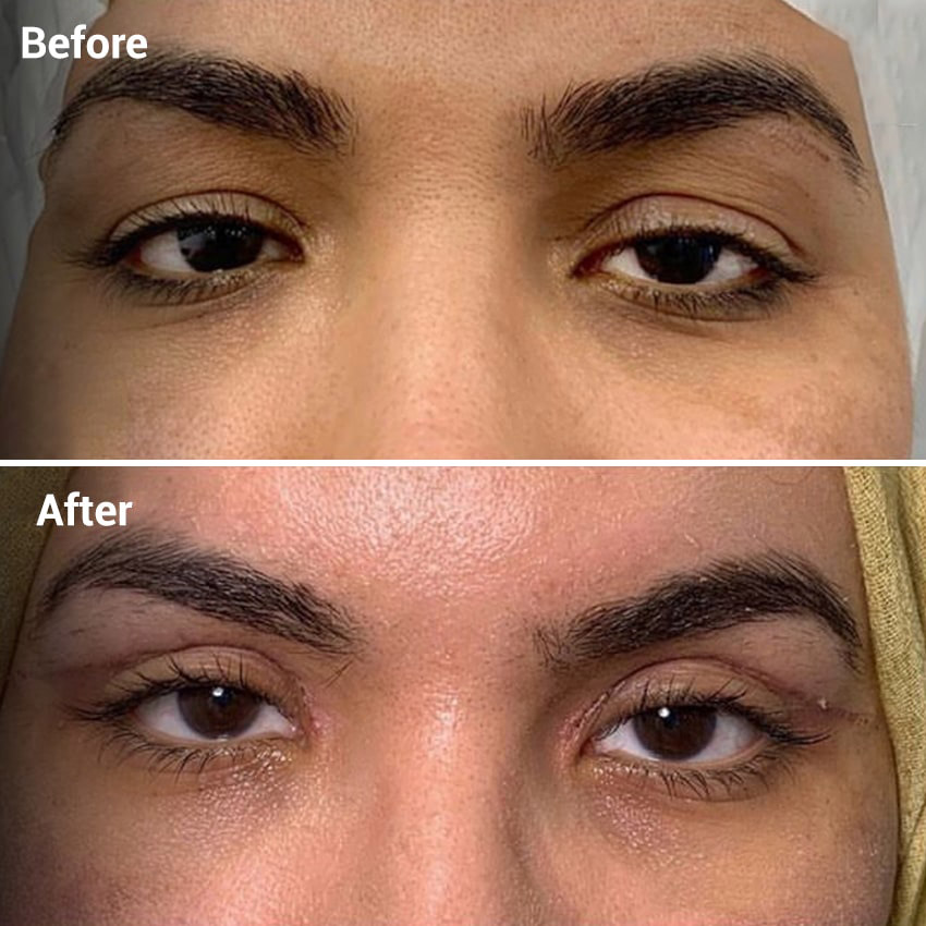 قبل و بعد لیفت اندوسکوپیک قبل و بعد لیفت اندوسکوپیک