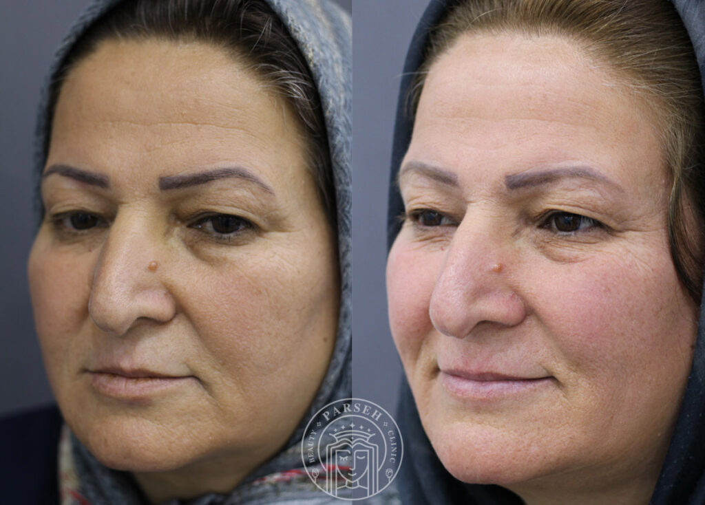 نتیجه فرکس پرو برای جوانسازی گونه نتیجه فرکس پرو برای جوانسازی گونه