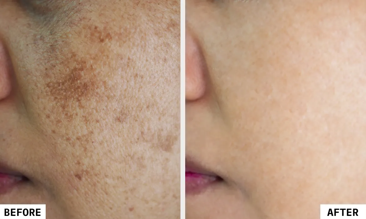 نتیجه لیزر کیوسوییچ برای خانم ها نتیجه لیزر کیوسوییچ برای خانم ها