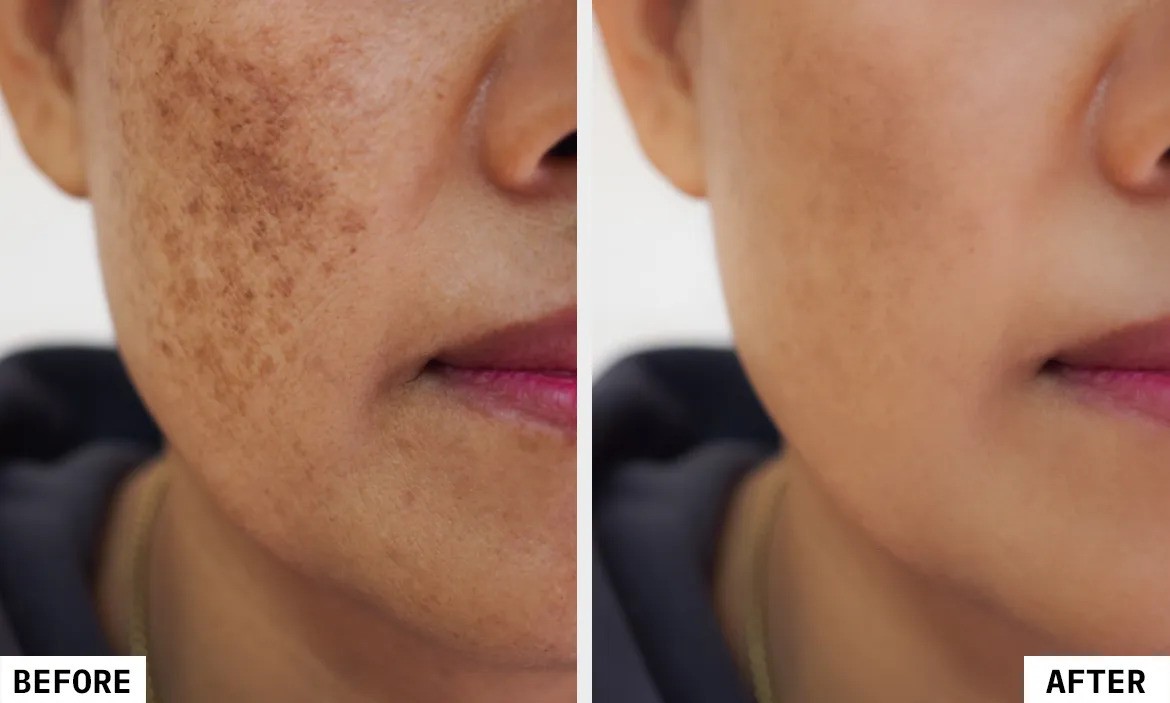 لیزر کیوسوییچ در شیراز