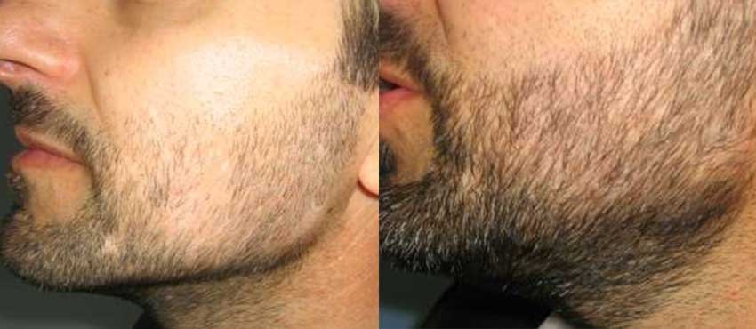 کاشت ریش کاشت ریش