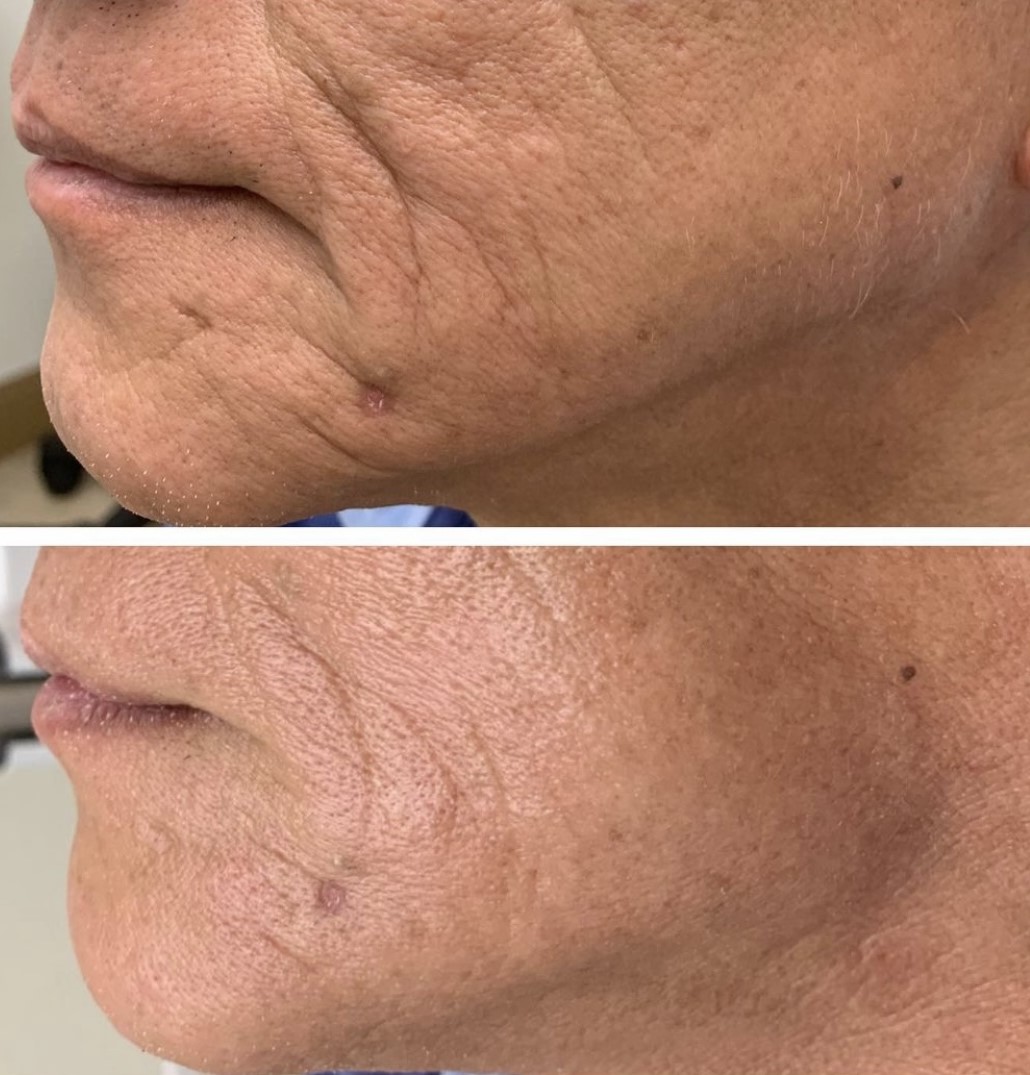 لیزر فوتونا برای زیبایی و جوانسازی پوست