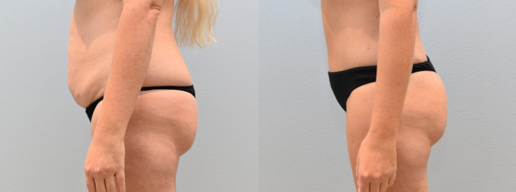 قبل و بعد لیپوساکشن قبل و بعد لیپوساکشن