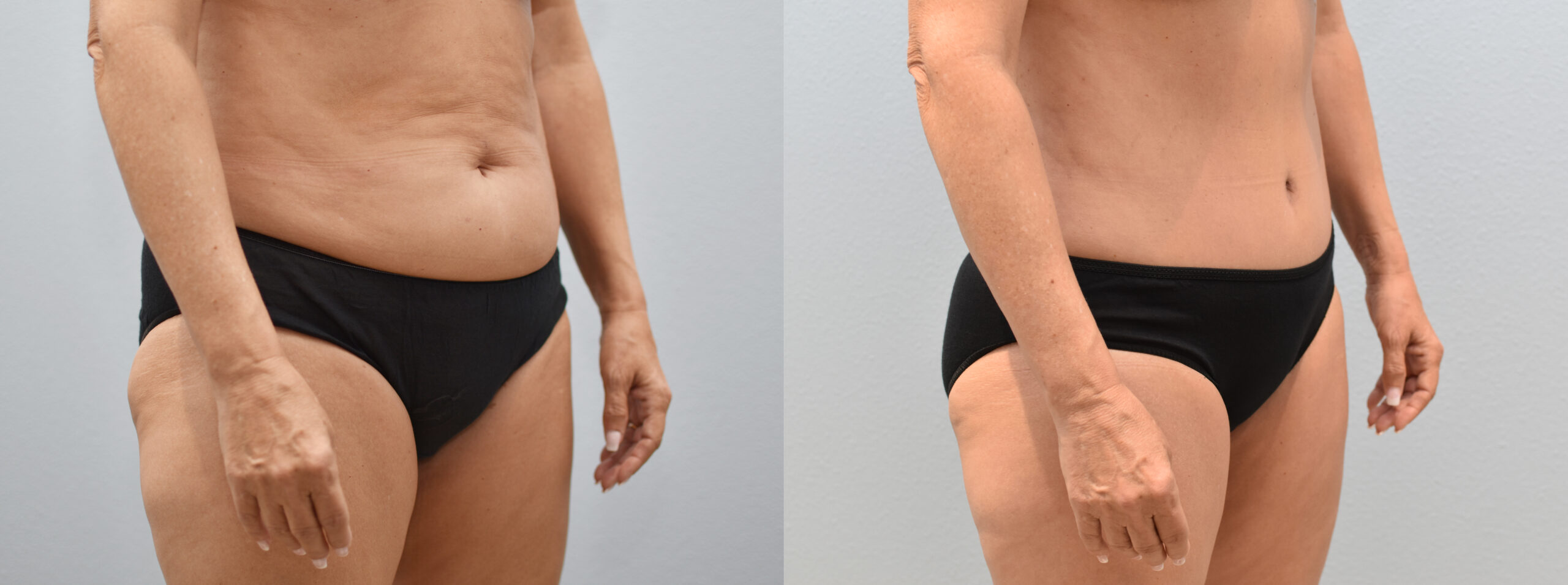 عکس قبل و بعد لیپوساکشن عکس قبل و بعد لیپوساکشن