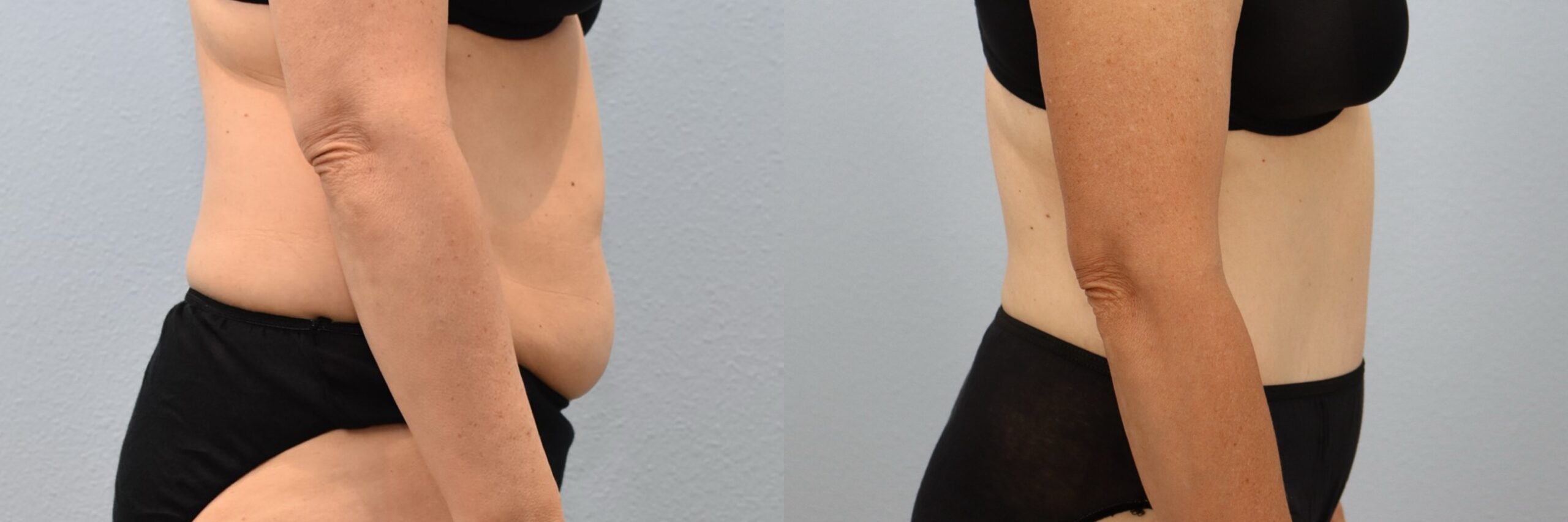 لیپوساکشن برای لاغری موضعی لیپوساکشن برای لاغری موضعی