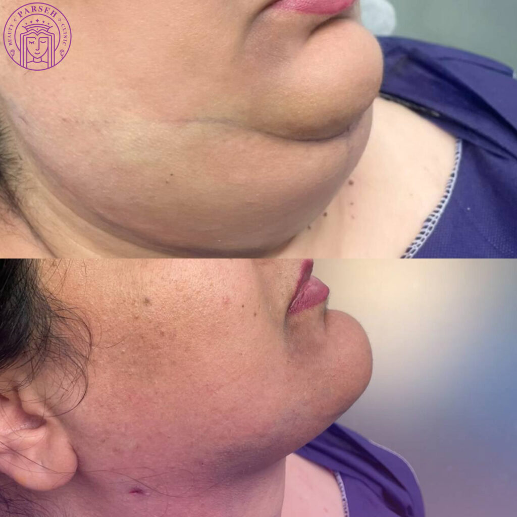 نتیجه قبل و بعد لیپوساکشن در شیراز نتیجه قبل و بعد لیپوساکشن در شیراز