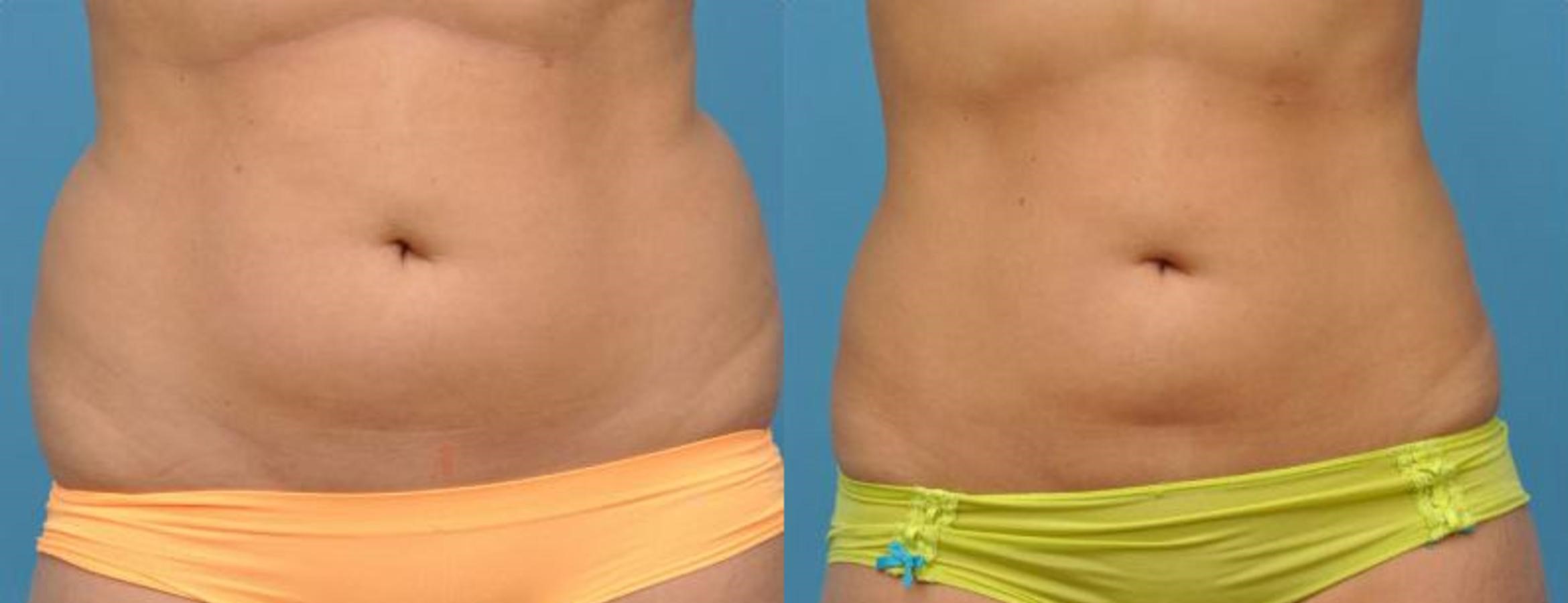 لیپوساکشن برای لاغری موضعی