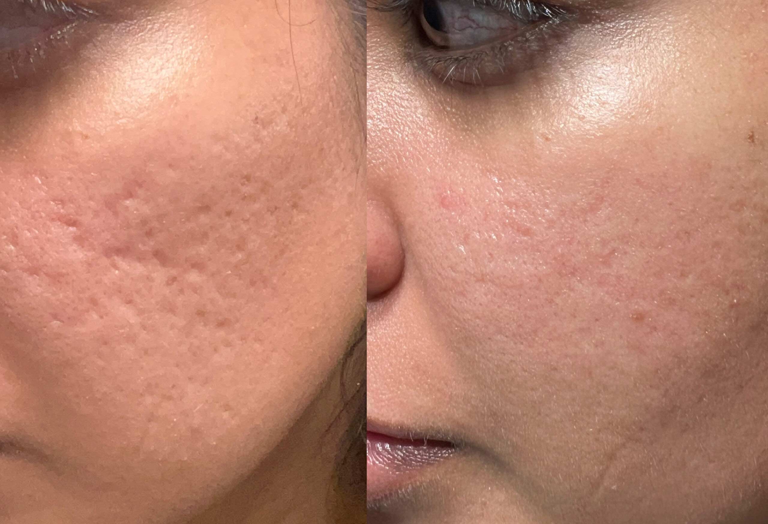 سابسیژن با تکنیک های ترکیبی