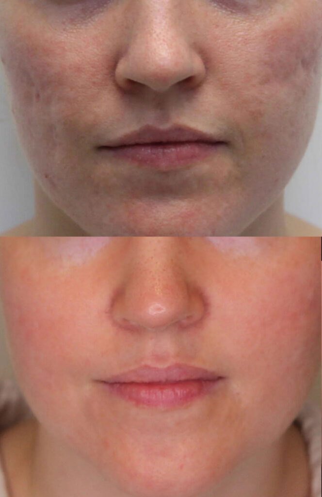 نتیجه سابسیژن صورت نتیجه سابسیژن صورت