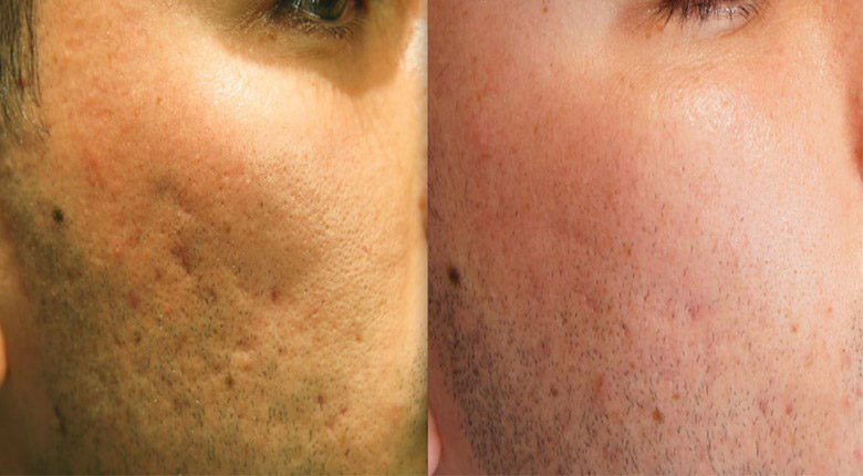 سابسیژن برای صورت سابسیژن برای صورت