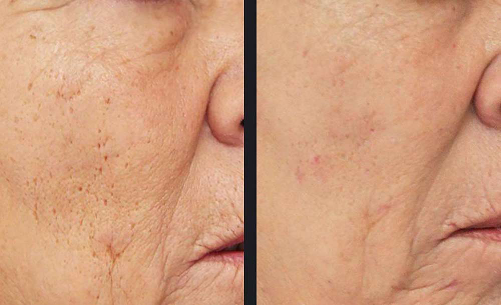 فرکس پرو برای چروک های سطحی پوست صورت فرکس پرو برای چروک های سطحی پوست صورت