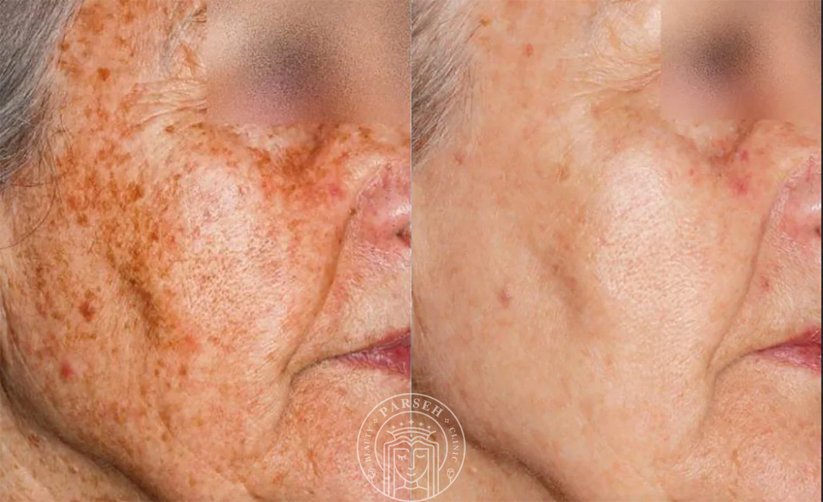 لیزر فرکس پرو برای آکنه و لکه های تیره