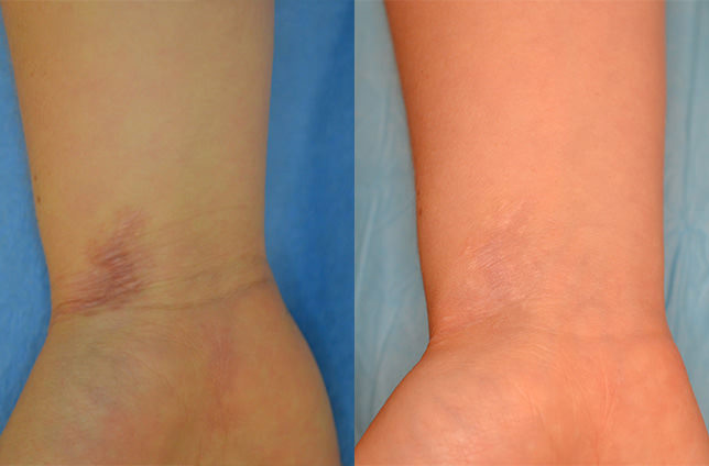 فرکس پرو برای درمان جای سوختگی دست فرکس پرو برای درمان جای سوختگی دست