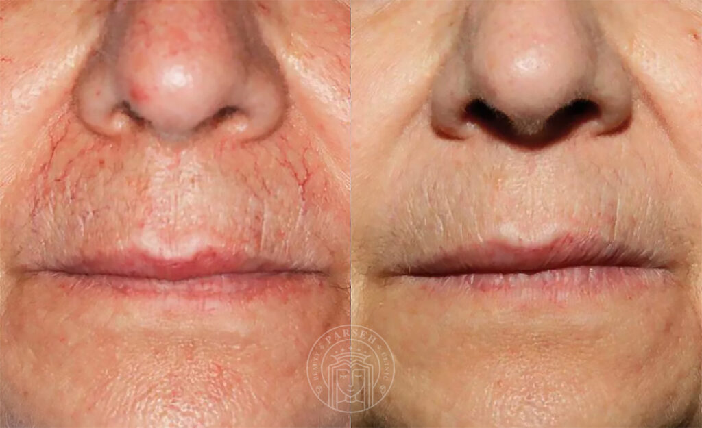 فرکس پرو برای درمان ترک های پوستی فرکس پرو برای درمان ترک های پوستی