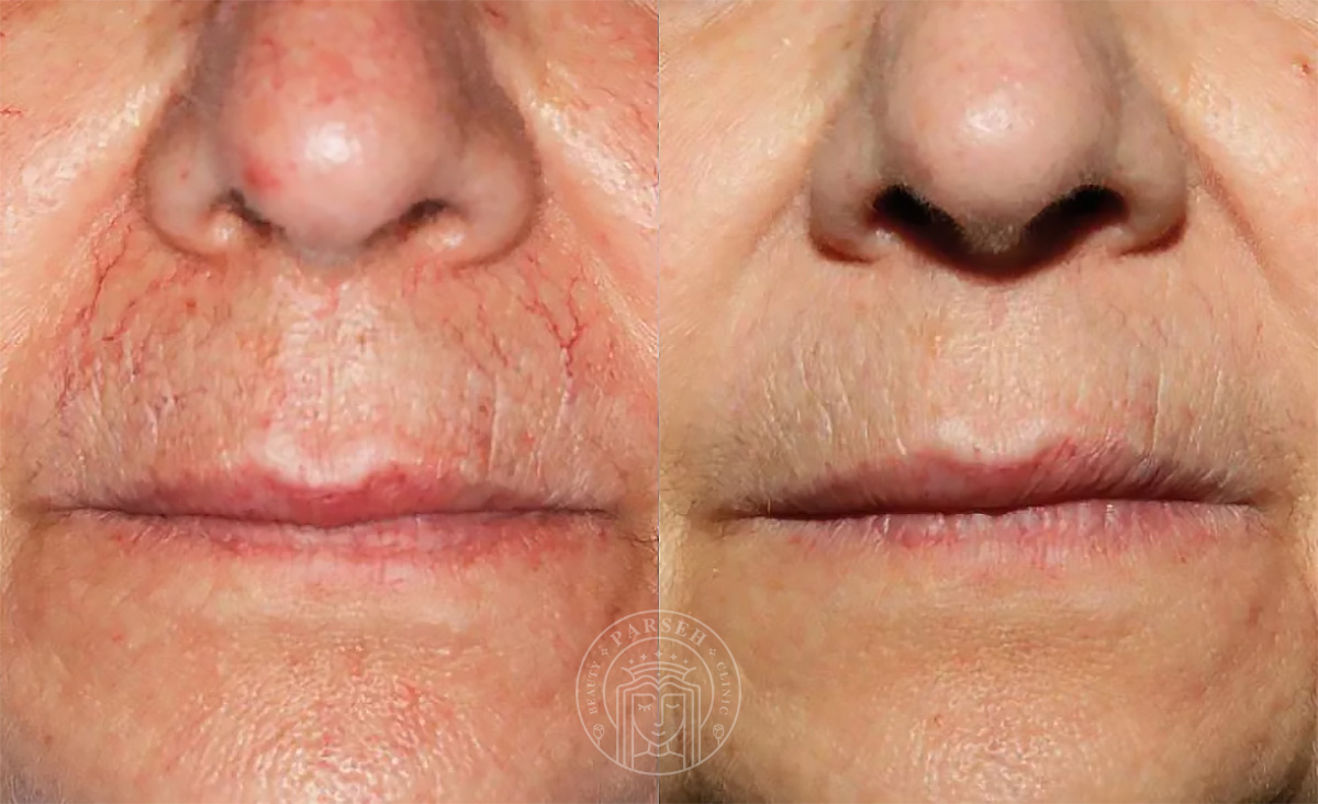 فرکس پرو برای درمان ترک های پوستی