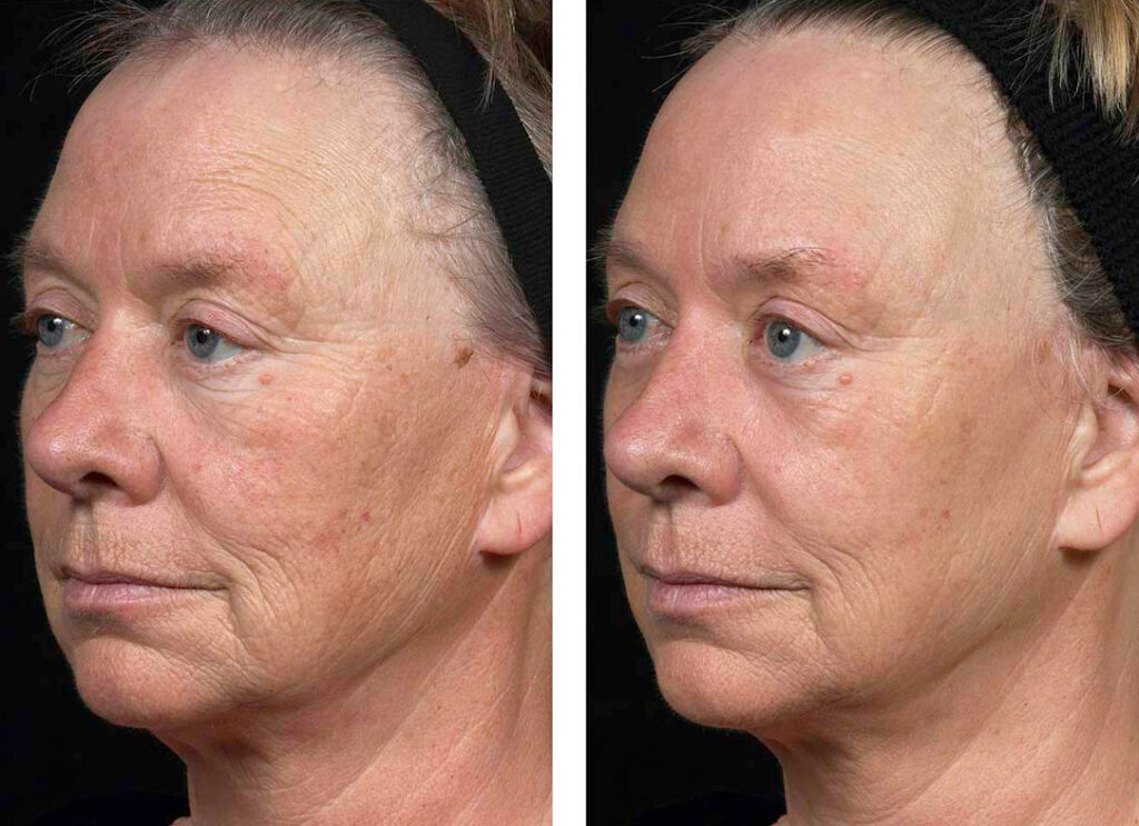 لیزر فرکس پرو برای چروک صورت لیزر فرکس پرو برای چروک صورت