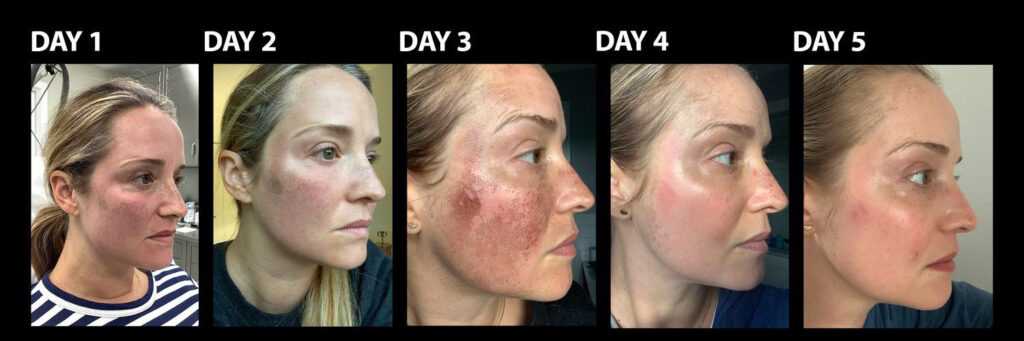 نتیجه لیزر فرکس پرو برای آکنه نتیجه لیزر فرکس پرو برای آکنه