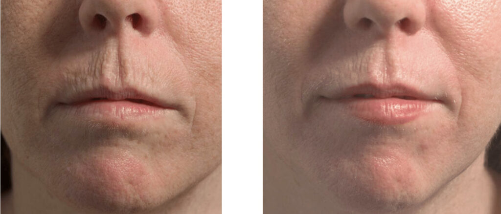 لیزر فرکس پرو برای ترک های سطحی صورت لیزر فرکس پرو برای ترک های سطحی صورت