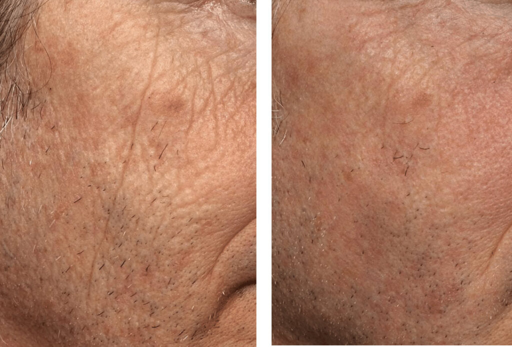 فرکس پرو برای ترک های پوست فرکس پرو برای ترک های پوست