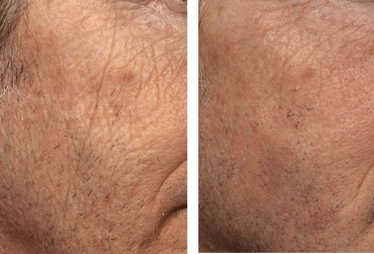 فرکس پرو برای ترک های پوست