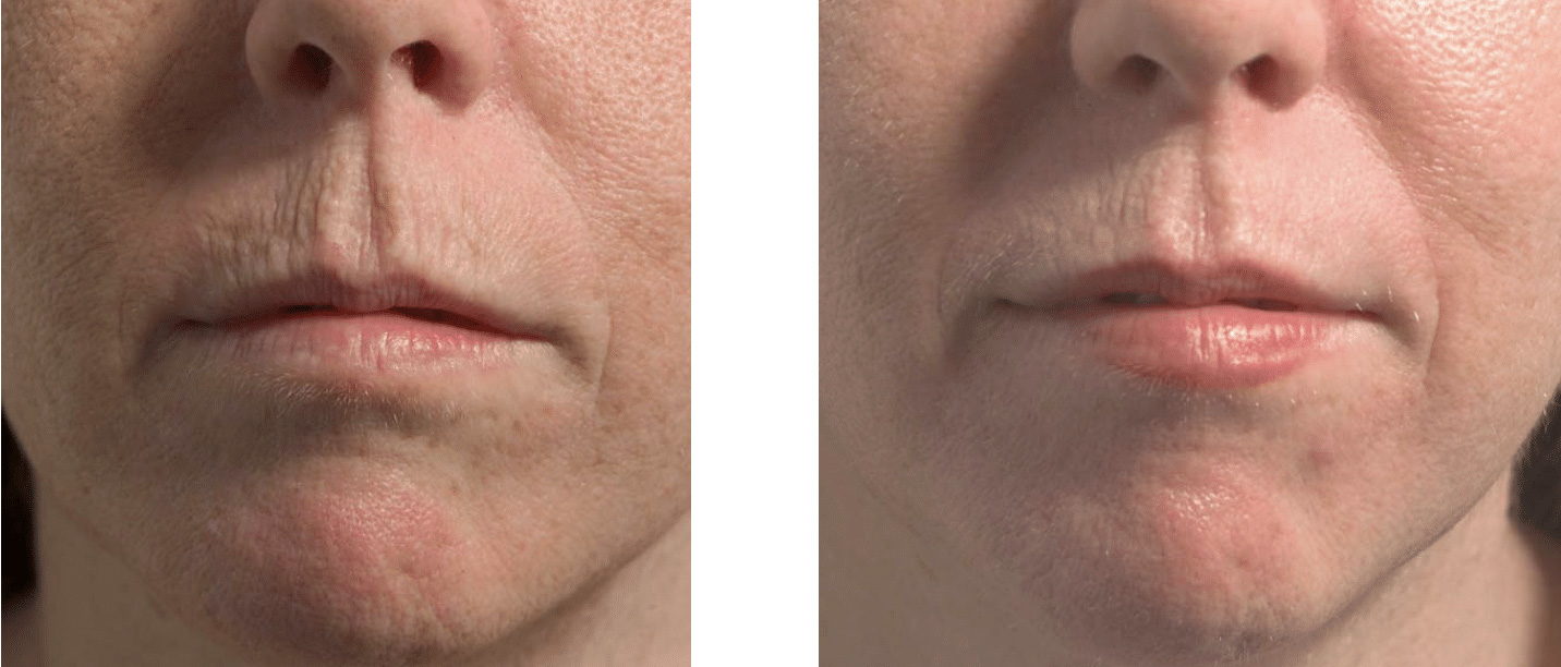 لیزر فرکس پرو برای ترک های سطحی صورت