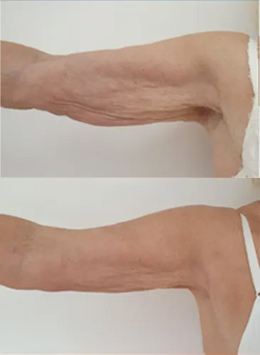 اندولیفت کردن بازو