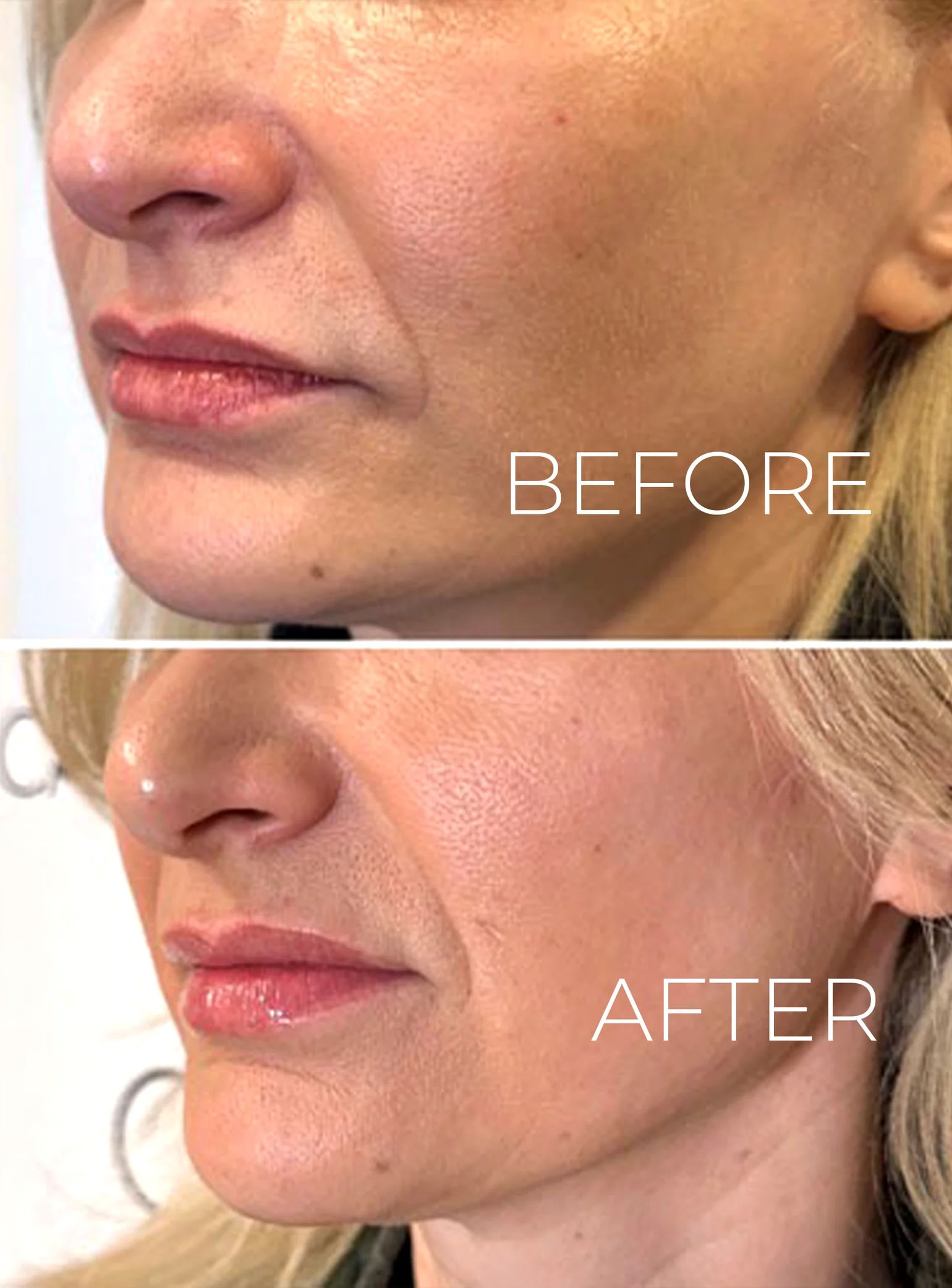 اندولیفت برای روشن شدن پوست