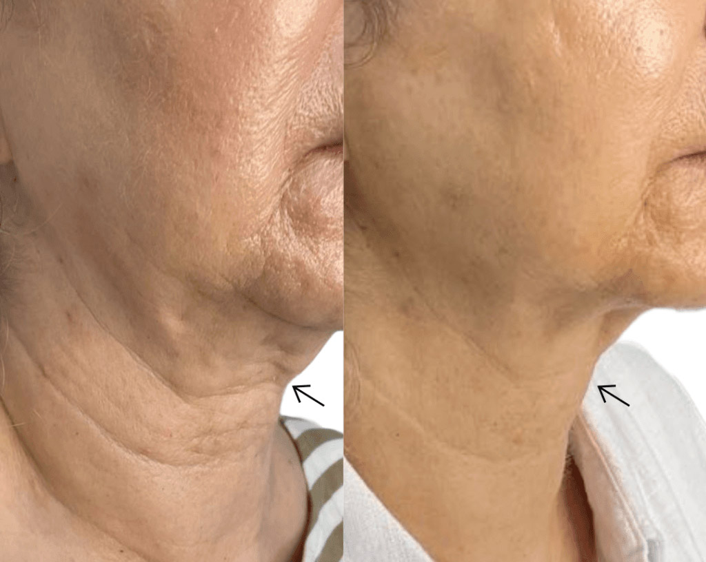 اندولیفت غبغب