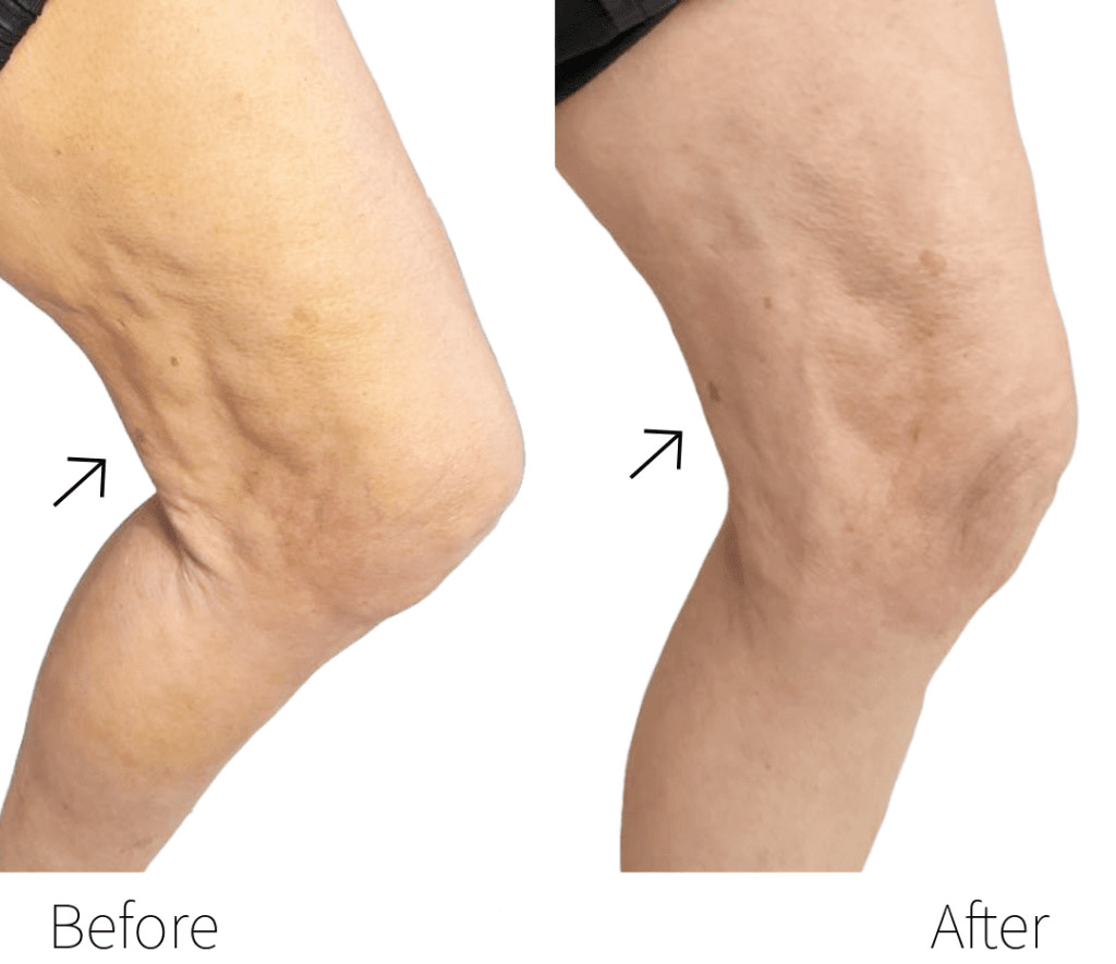 قبل و بعد اندولیفت ران