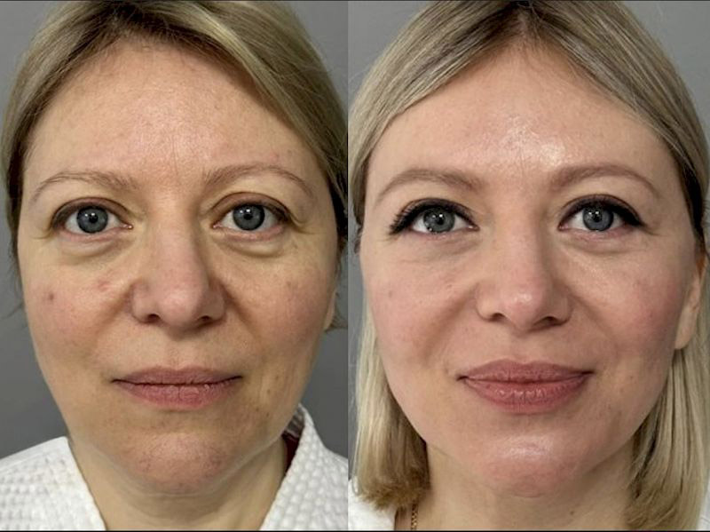 اندولیفت برای روشن شدن پوست