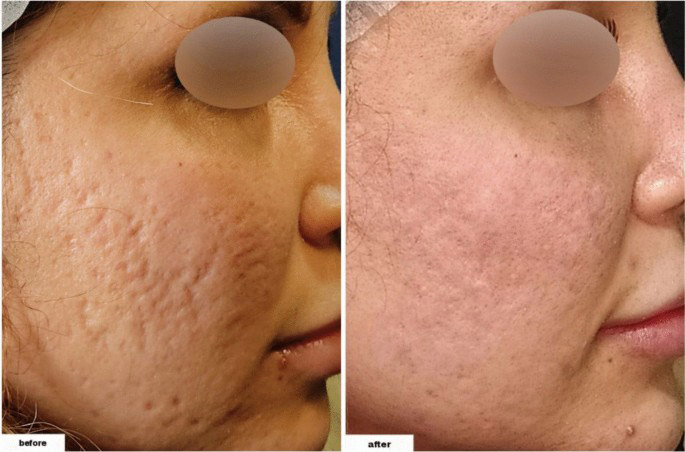 ترکیب اندولیفت با سابسیژن