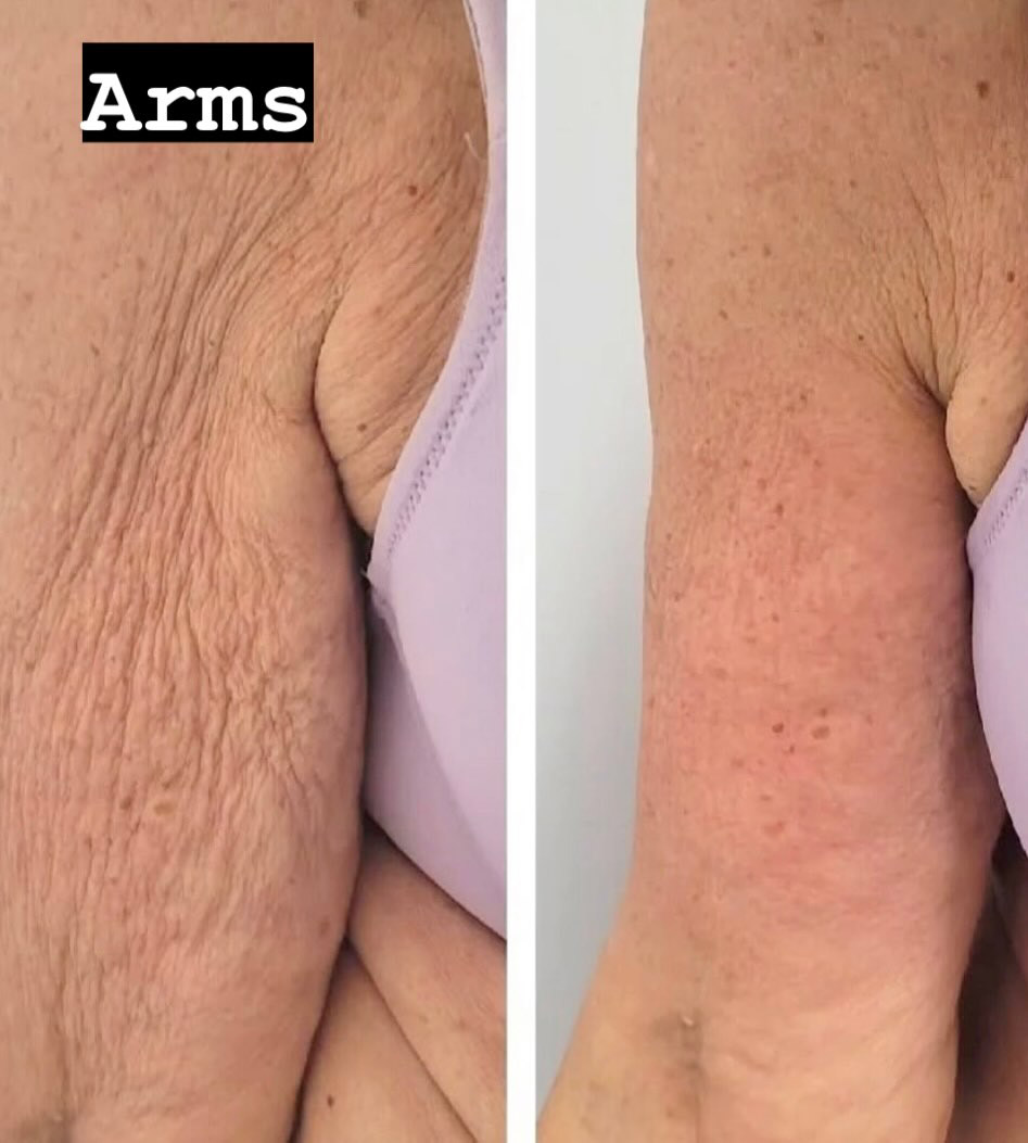 قبل و بعد اندولیفت بازو