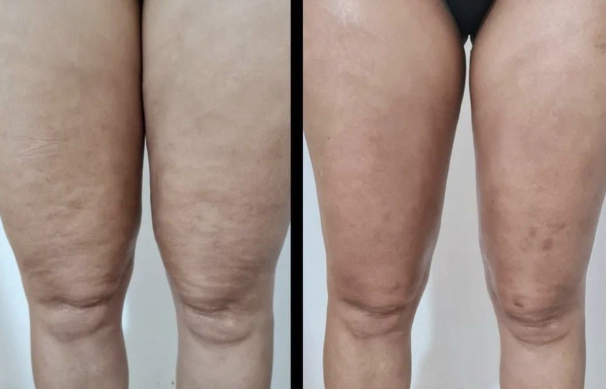 اندولیفت ران