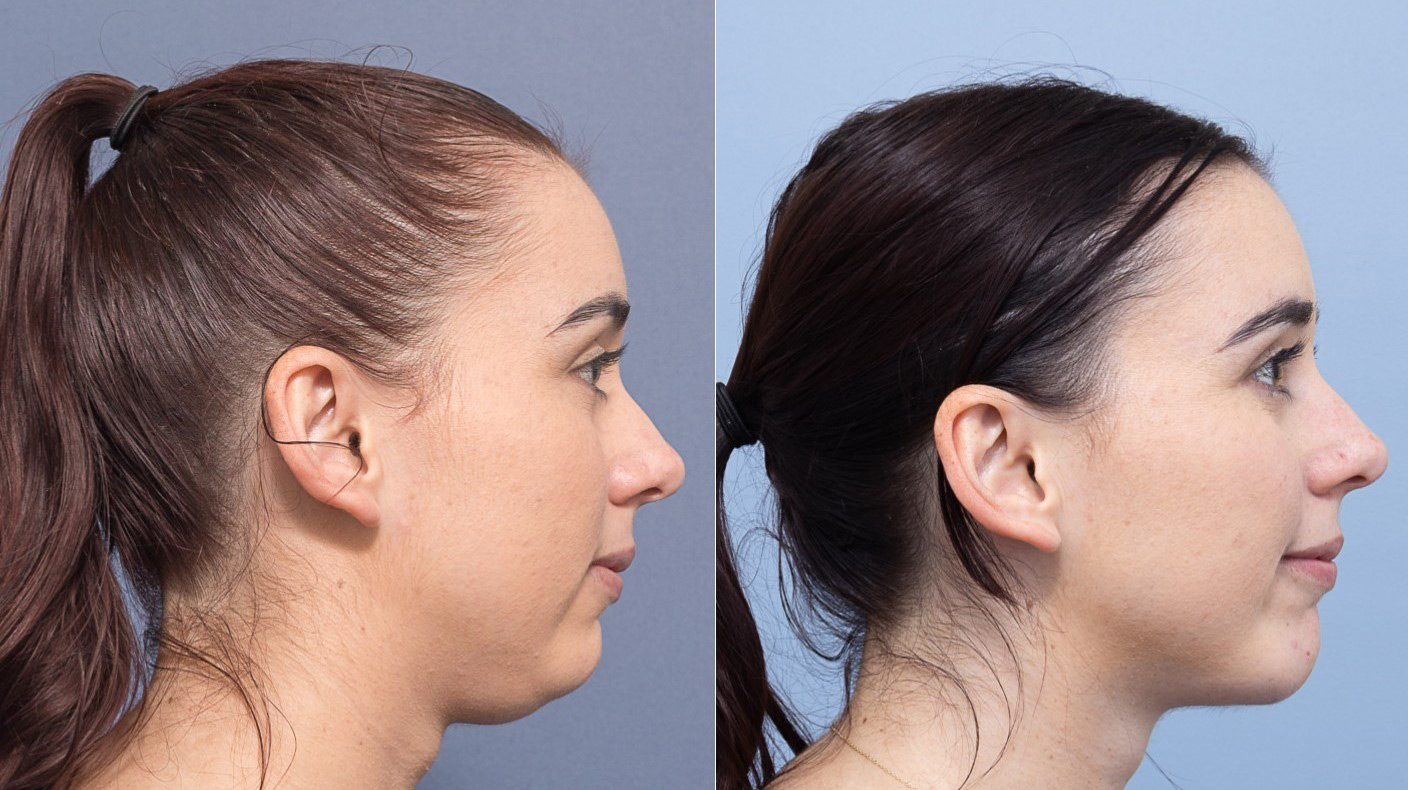 قبل و بعد لیپوساکشن غبغب قبل و بعد لیپوساکشن غبغب