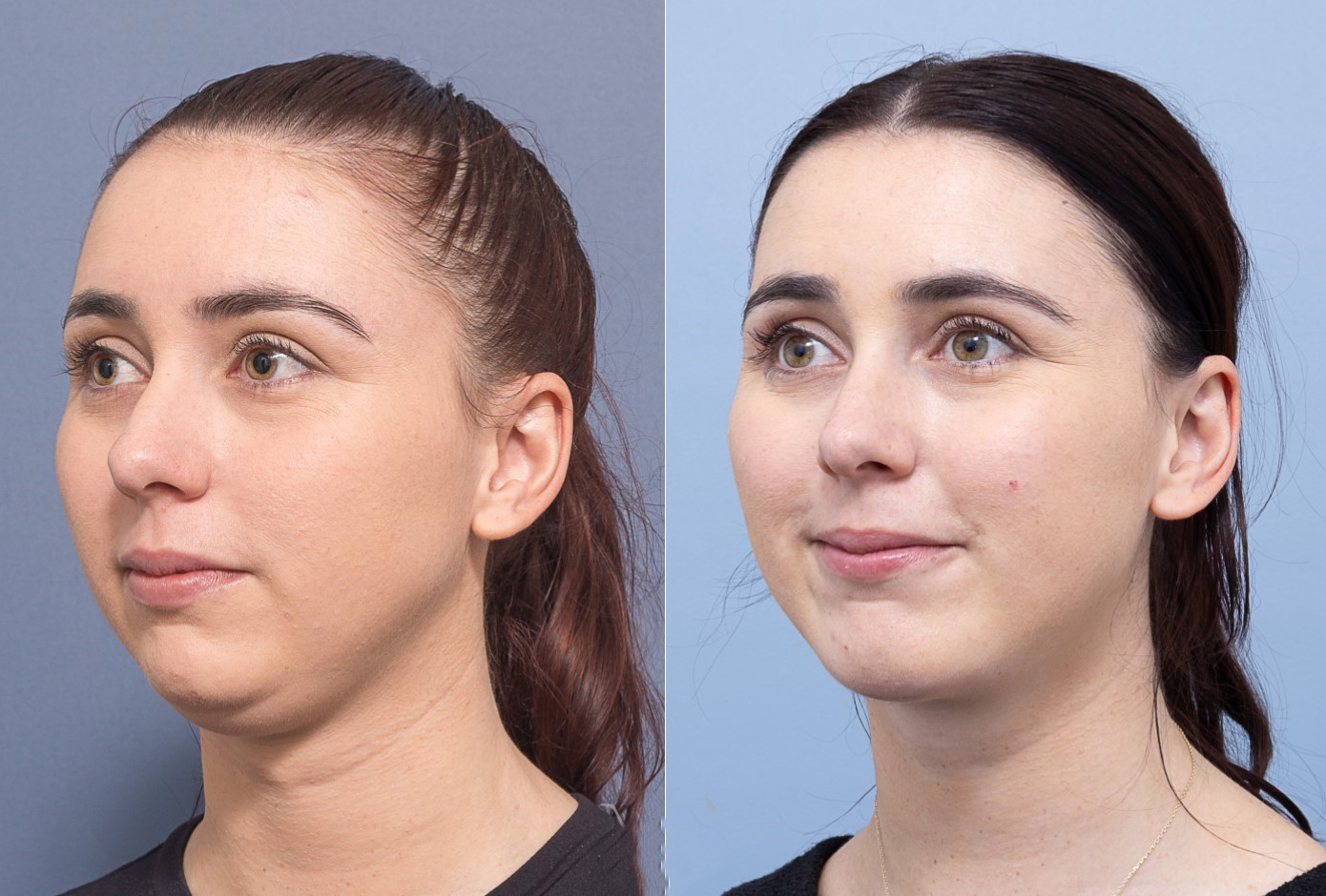 لیپوساکشن غبغب لیپوساکشن غبغب