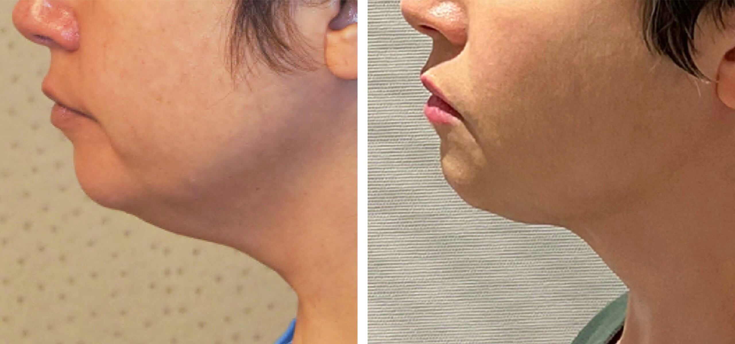 لیپوساکشن غبغب شیراز لیپوساکشن غبغب شیراز