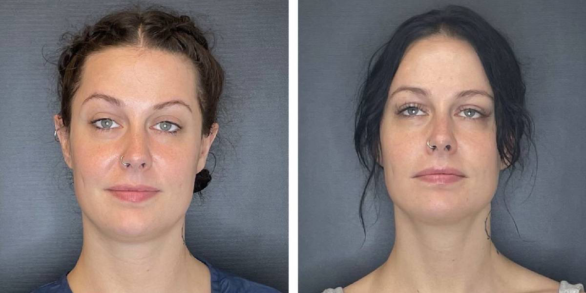 لیپوساکشن صورت و گونه