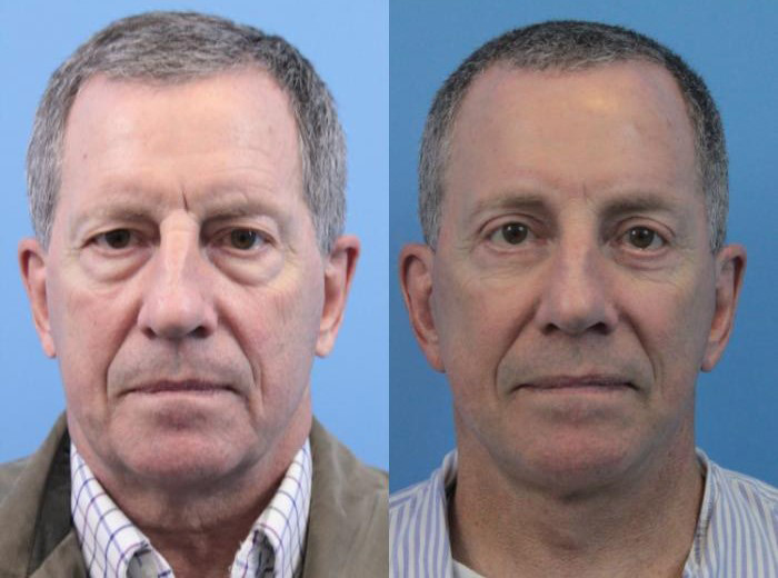 لیپوساکشن صورت و گونه آقایان