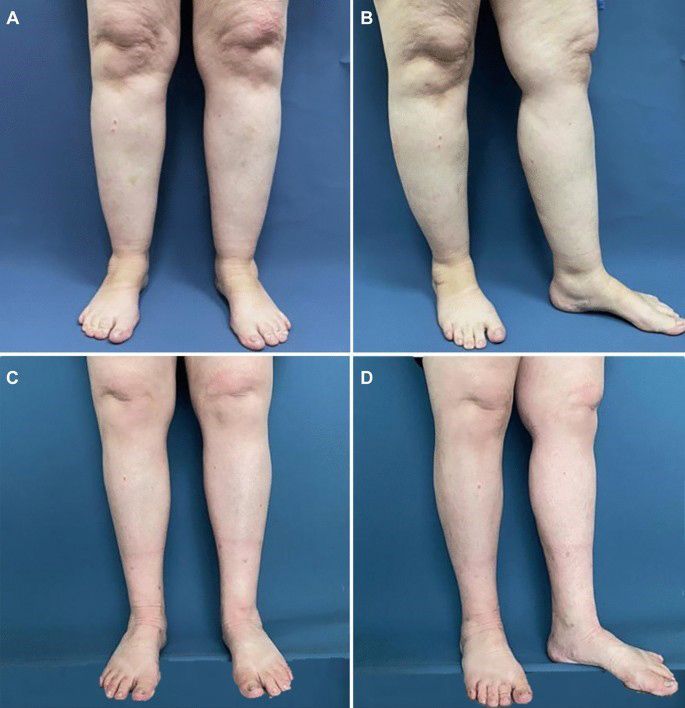 لیپوساکشن پا در شیراز لیپوساکشن پا در شیراز