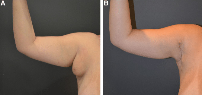 لیپوساکشن زیر بغل شیراز