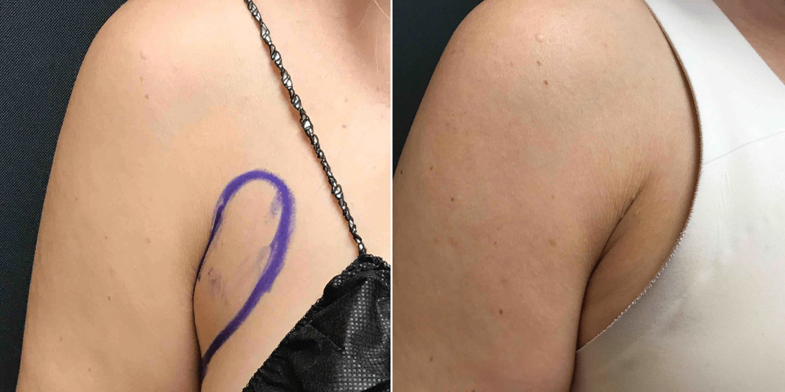 لیپوساکشن زیر بغل شیراز