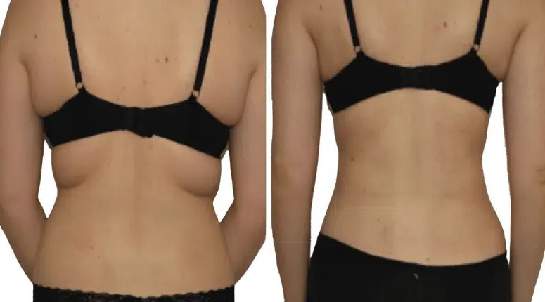 قبل و بعد لیپوساکشن کمر شیراز